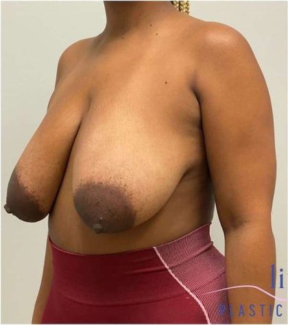 Breast Lift Before & After Patient #1098