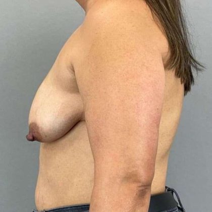 Breast Lift Before & After Patient #1109