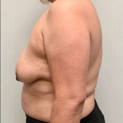 Breast Lift Before & After Patient #1120
