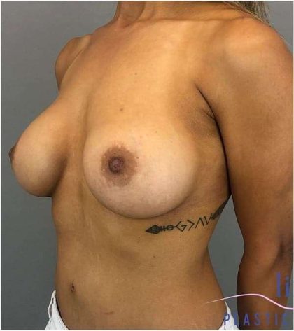 Breast Implant Exchange Before & After Patient #1164