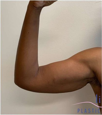 Arm Lift Before & After Patient #193