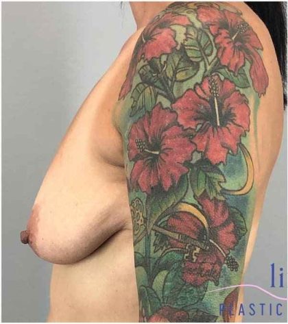 Breast Augmentation Before & After Patient #1197