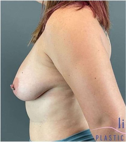 Breast Augmentation Before & After Patient #1208