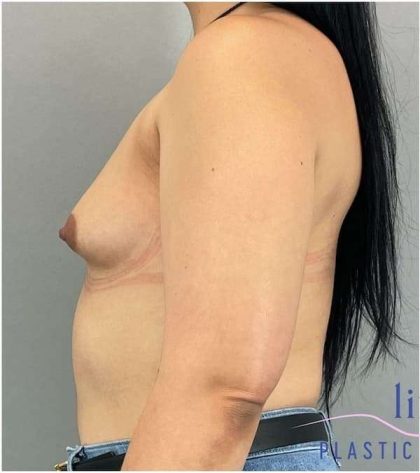 Breast Augmentation Before & After Patient #1219