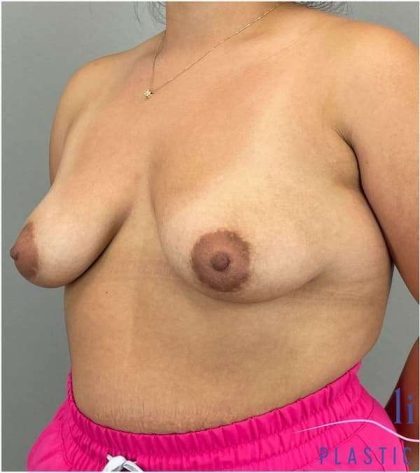 Breast Augmentation Before & After Patient #1230