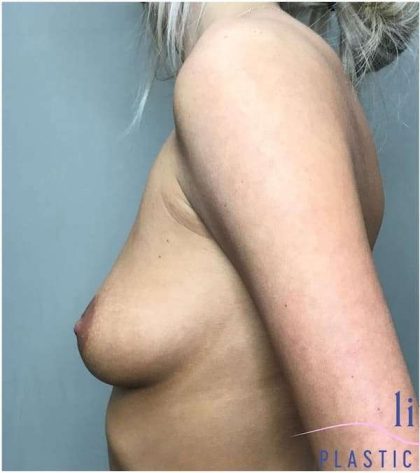 Breast Augmentation Before & After Patient #1241