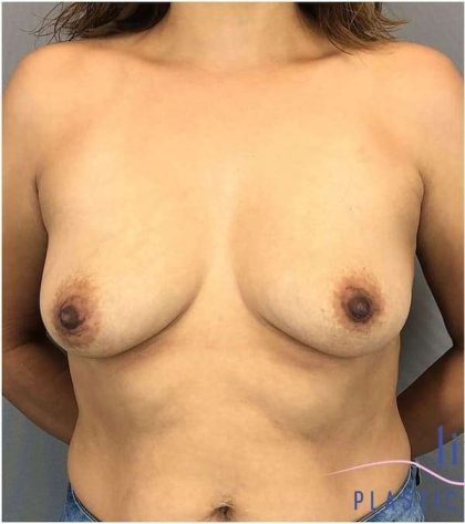 Breast Augmentation Before & After Patient #1274