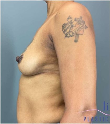 Breast Augmentation Before & After Patient #1296