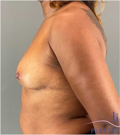 Breast Augmentation Before & After Patient #1307