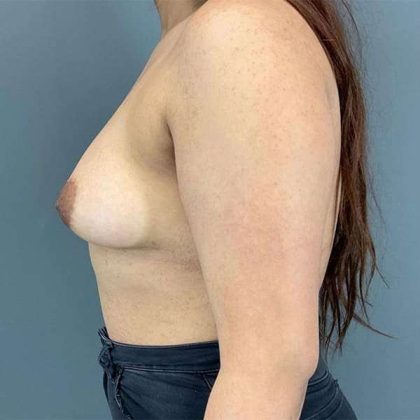 Breast Augmentation Before & After Patient #1318