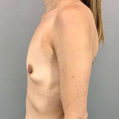 Breast Augmentation Before & After Patient #1329