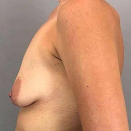 Breast Augmentation Before & After Patient #1351