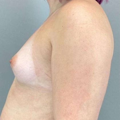 Breast Augmentation Before & After Patient #1362