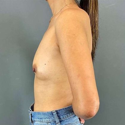 Breast Augmentation Before & After Patient #1373