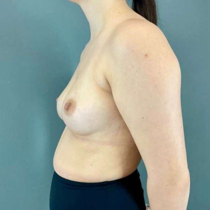 Breast Augmentation Before & After Patient #1406