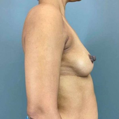 Breast Augmentation Before & After Patient #1428