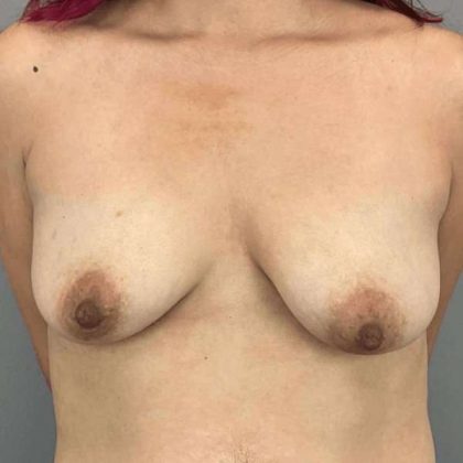 Breast Augmentation Before & After Patient #1461
