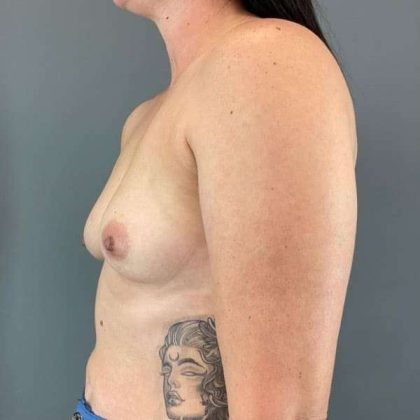 Breast Augmentation Before & After Patient #1472