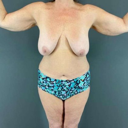 Arm Lift Before & After Patient #210