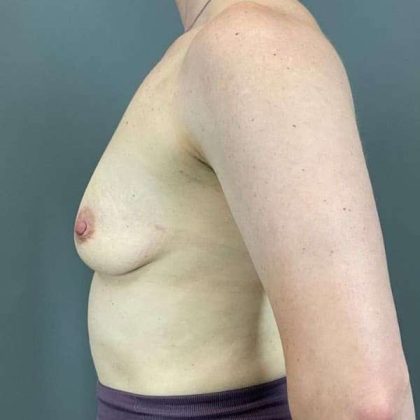 Breast Augmentation Before & After Patient #1547
