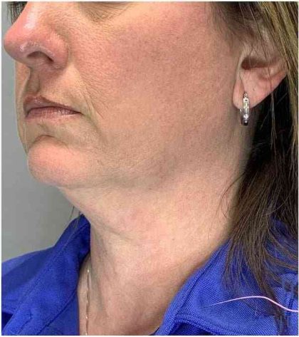 Necktite Before & After Patient #1624