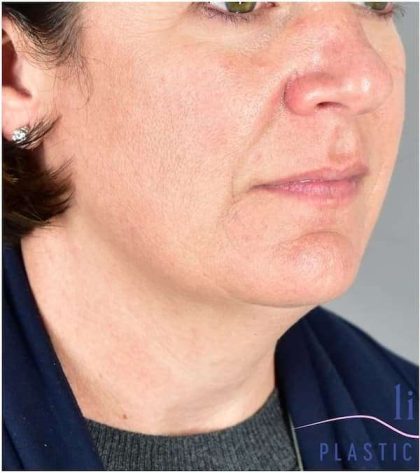 Necktite Before & After Patient #1633