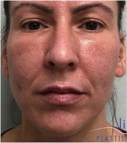 Necktite Before & After Patient #1642