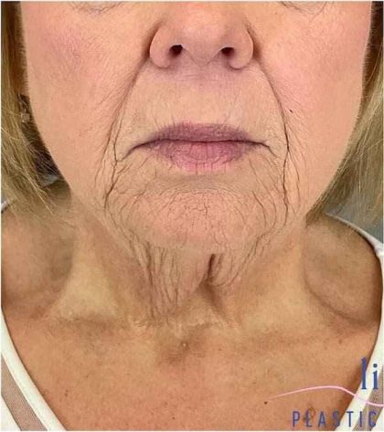 Neck Lift Before & After Patient #1649