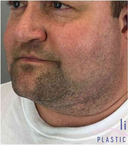Neck Lift Before & After Patient #1660