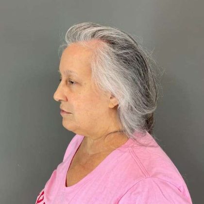 Neck Lift Before & After Patient #1671