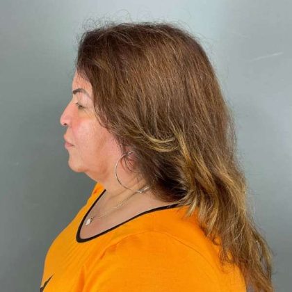 Neck Lift Before & After Patient #1678