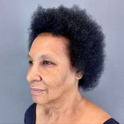 Neck Lift Before & After Patient #1685
