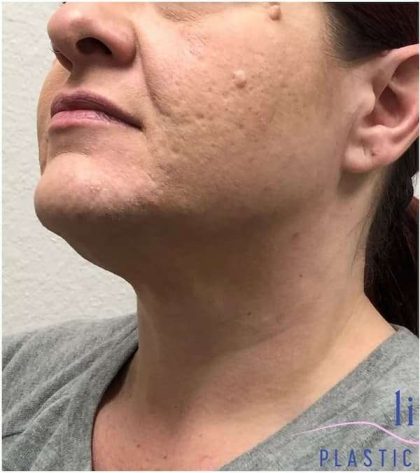 Neck Lift Before & After Patient #1696