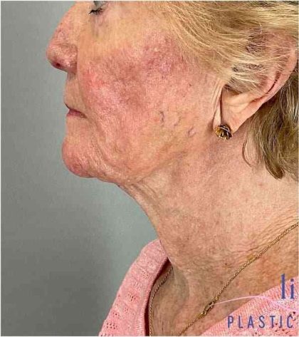 Facelift Before & After Patient #1703