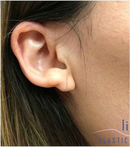 Ear Surgery Before & After Patient #1708