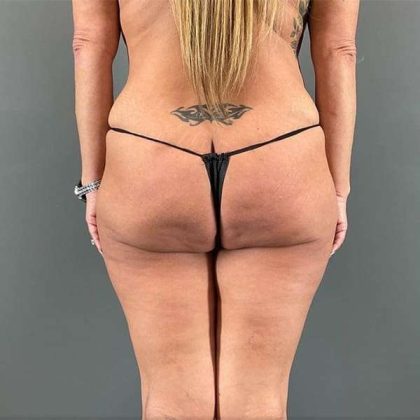 Thigh Lift Before & After Patient #233