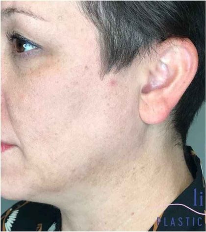 Ear Surgery Before & After Patient #1724