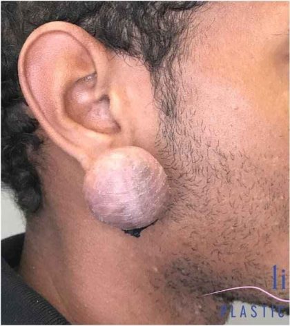 Ear Surgery Before & After Patient #1731