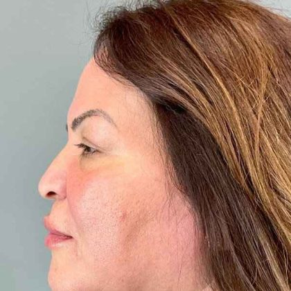 Eyelid Surgery Before & After Patient #1754