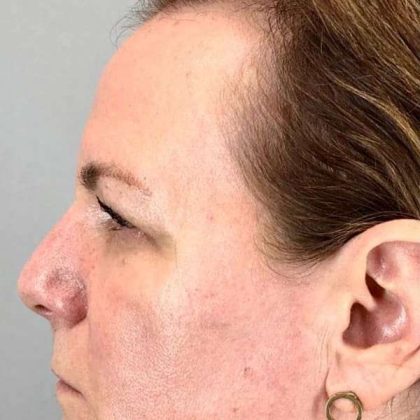 Eyelid Surgery Before & After Patient #1768