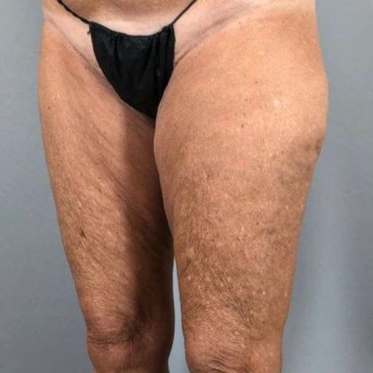 Thigh Lift Before & After Patient #240