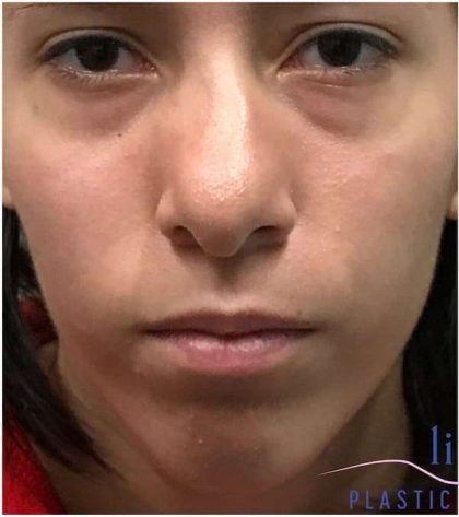 Rhinoplasty Before & After Patient #1796