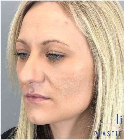 Rhinoplasty Before & After Patient #1807