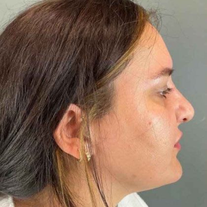 Rhinoplasty Before & After Patient #1818