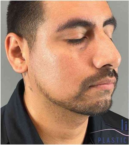 Rhinoplasty Before & After Patient #1825