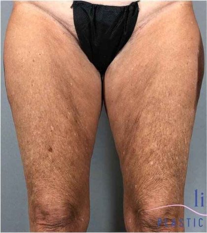 Thigh Lift Before & After Patient #247
