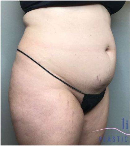 Bodytite Before & After Patient #258