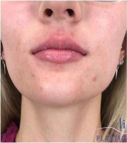 Injectables&Fillers Before & After Patient #130