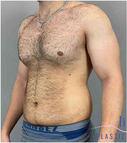 Bodytite Before & After Patient #280
