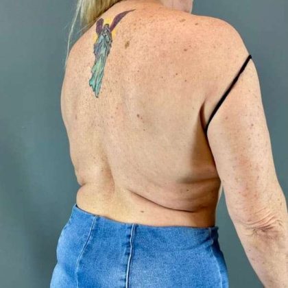 Back Lift Before & After Patient #287